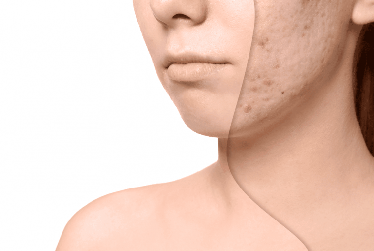 The Best Acne Scar Removal Therapy - removal, laser skin, dermal fillers, acne scar